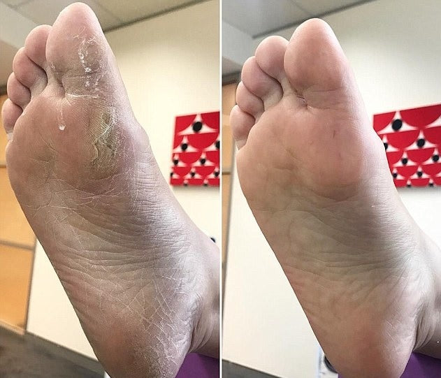 🌟 Electric Pedi ELIMINA CALLOS - 70% de los adultos tiene talones ásperos! 🌟