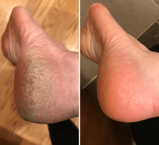 🌟 Electric Pedi ELIMINA CALLOS - 70% de los adultos tiene talones ásperos! 🌟